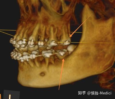 正畸导致颞下颌关节紊乱的原因+张口多少宽度算正常 - 知乎