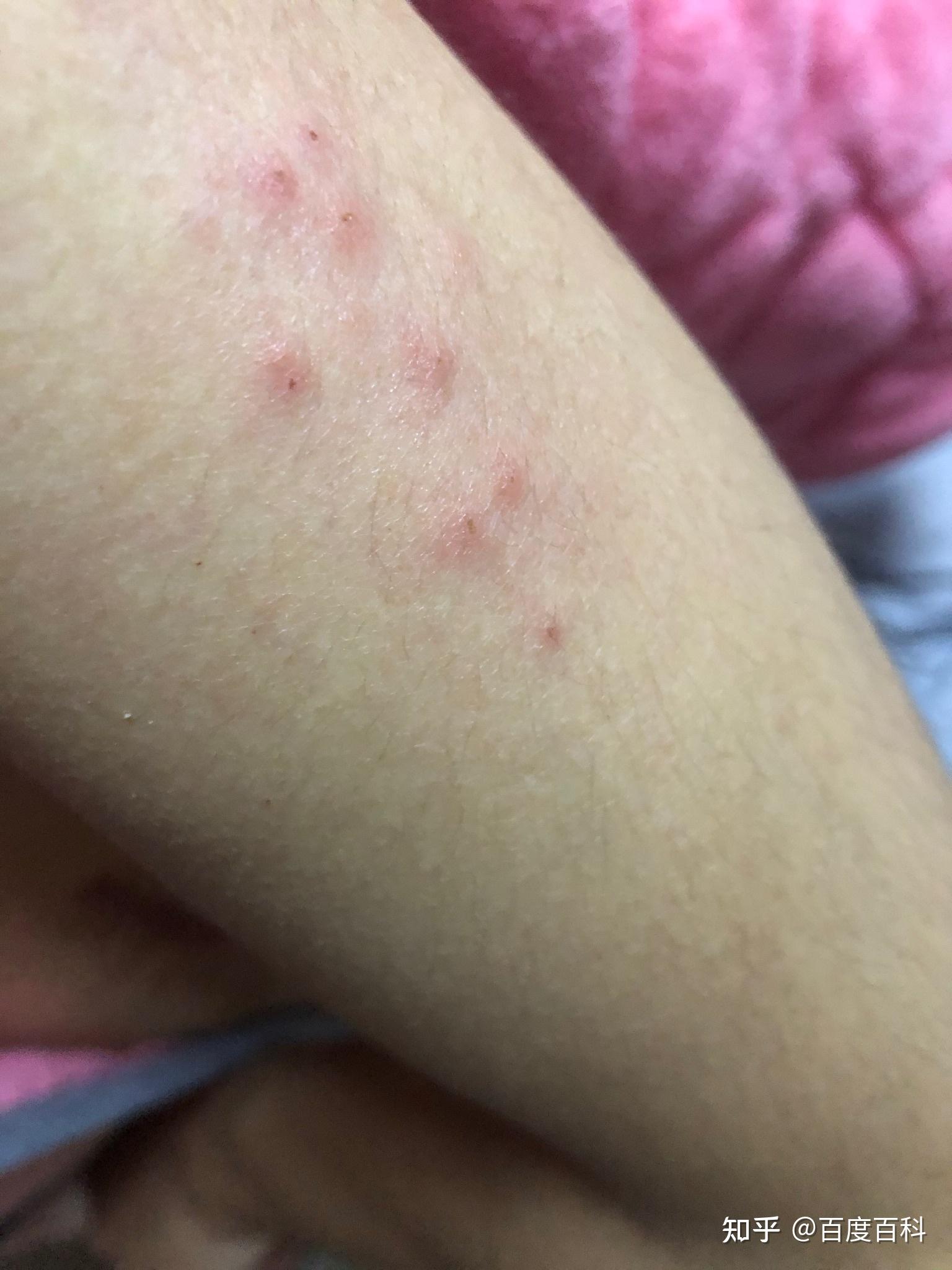 皮肤上起红点,还很痒 - 知乎