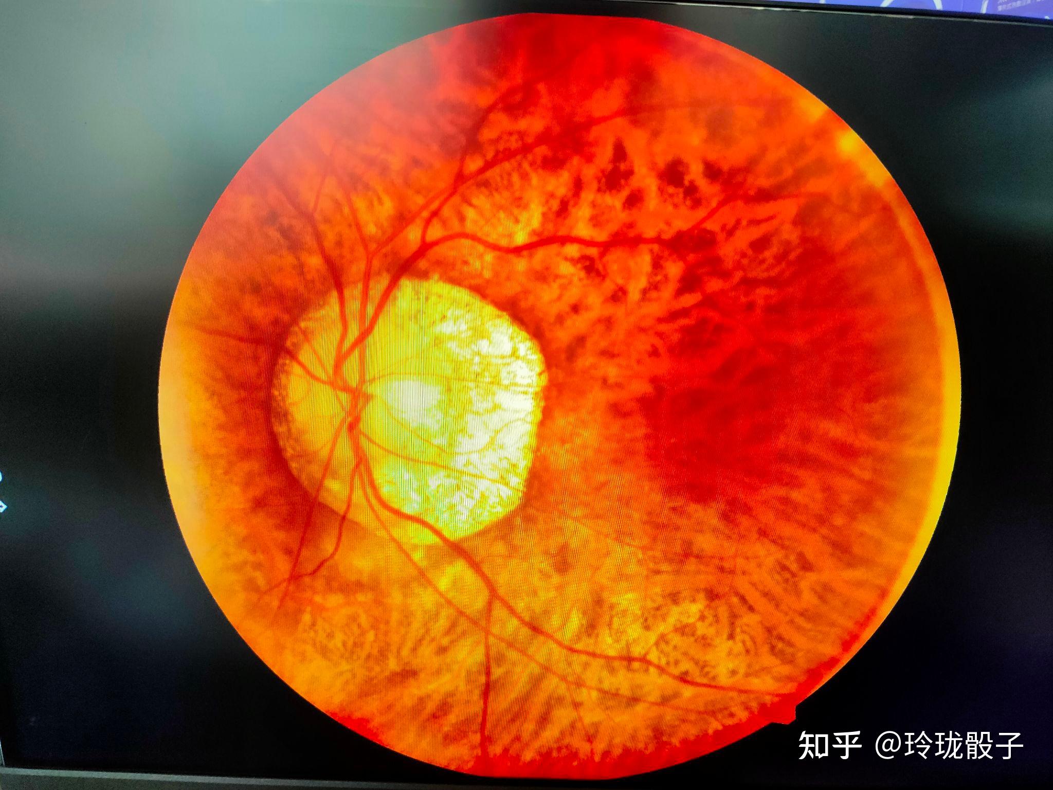 视网膜roth斑图片