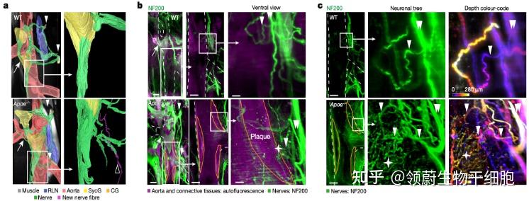 自然動脈粥樣硬化竟然和大腦相關科學家首次發現神經系統可直接調控