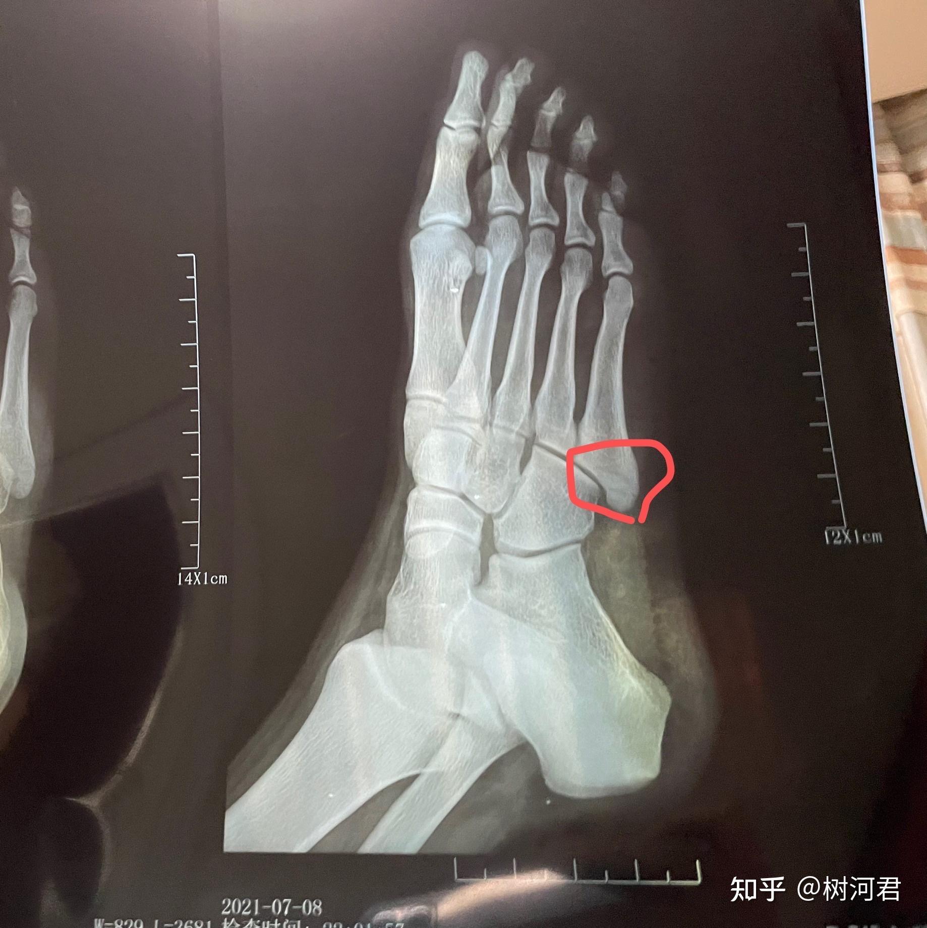 左第5跖骨骨折正常图图片
