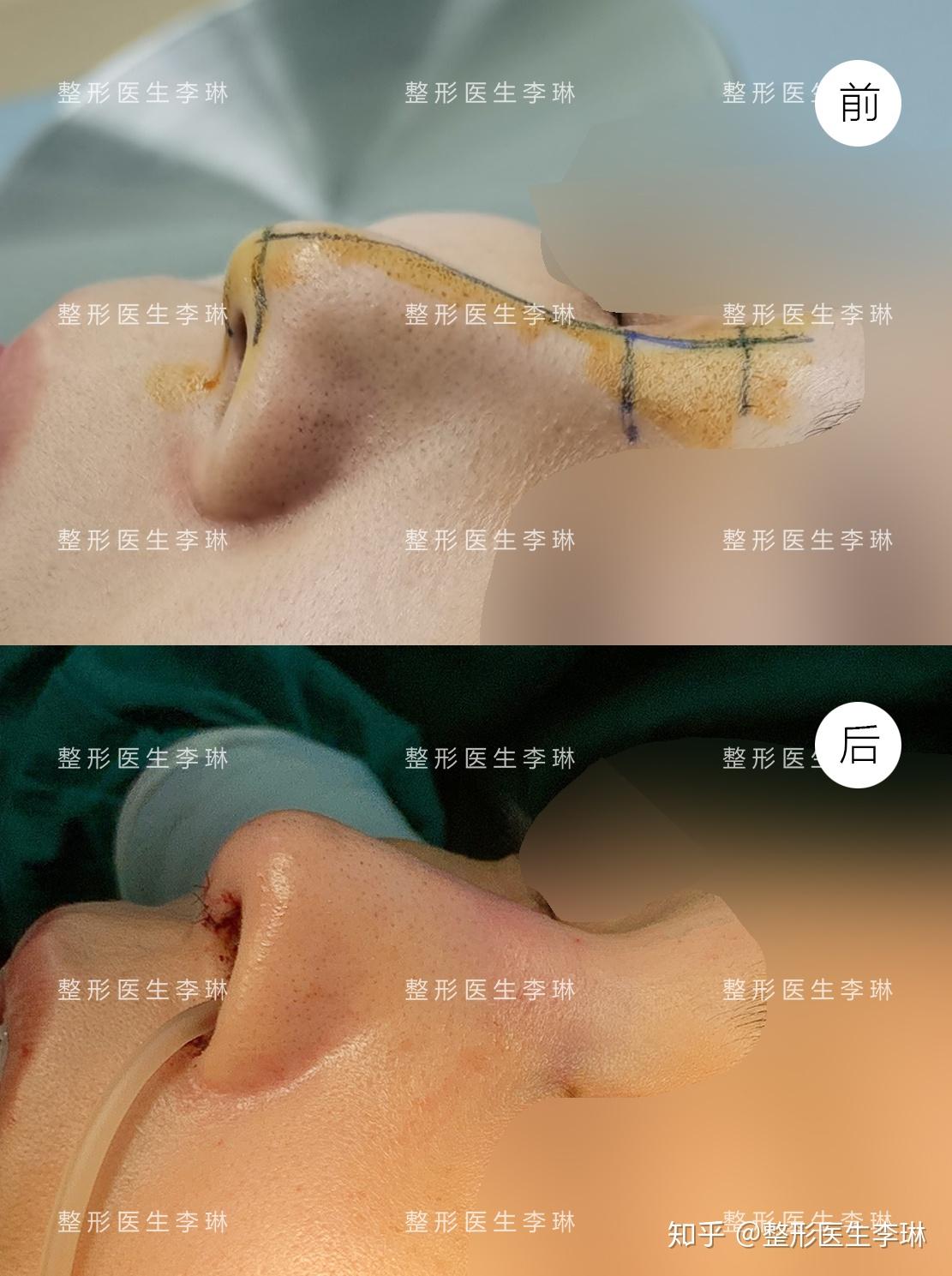 此次给她重新做了短鼻延长,把鼻小柱下拉,鼻尖下小叶下突,既缩短了