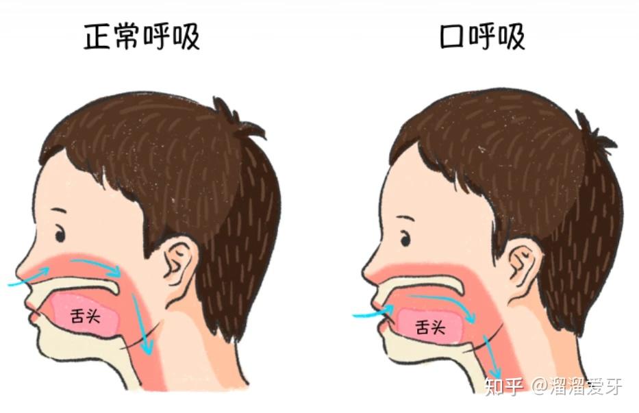儿童口呼吸原因是什么?