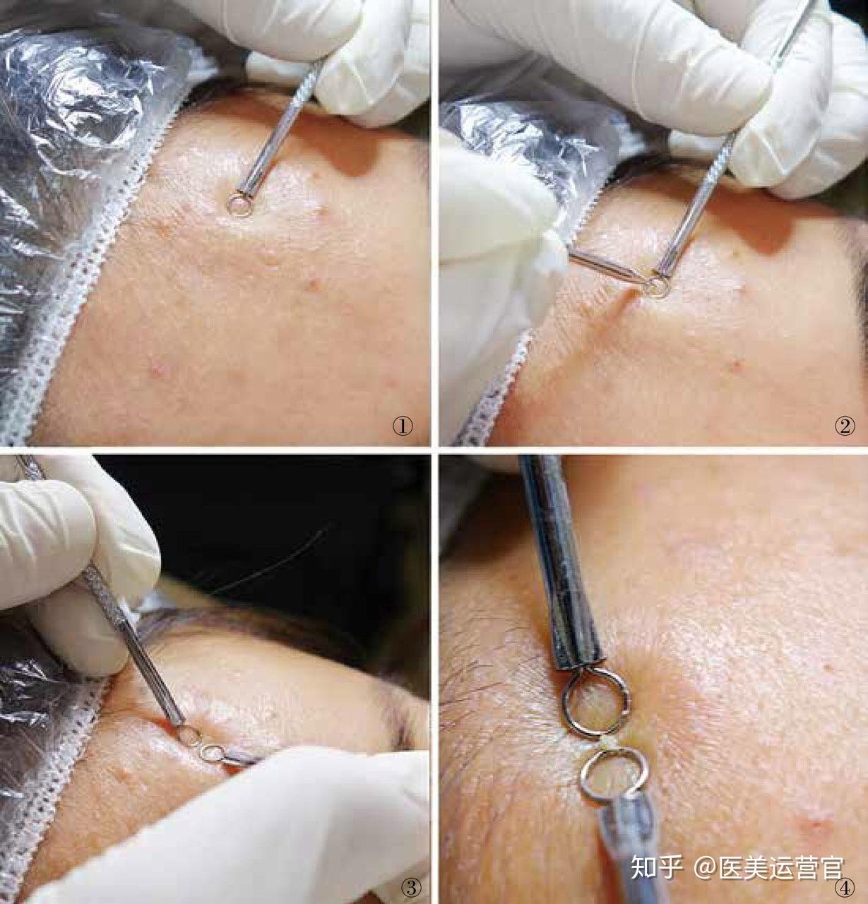 器)粉刺角栓的清除(也就是大家平常所说的"挤痘痘")很早就受到重视,是