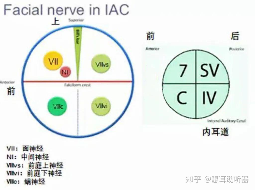 听神经细小系列科普|（一）如何精准诊断听神经细小(影像学特征) - 知乎