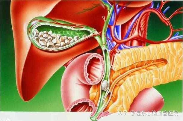 哈爾濱保膽取石醫院無症狀的膽囊結石有必要治療嗎保膽取石正當時