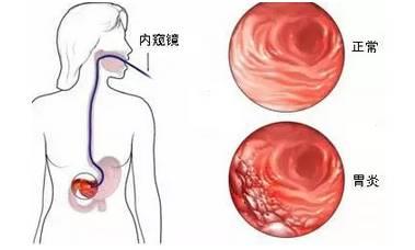 慢性浅表性胃炎非萎缩性胃炎不需要治疗