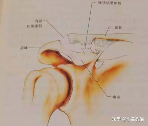 肩锁关节损伤及治疗方法 知乎