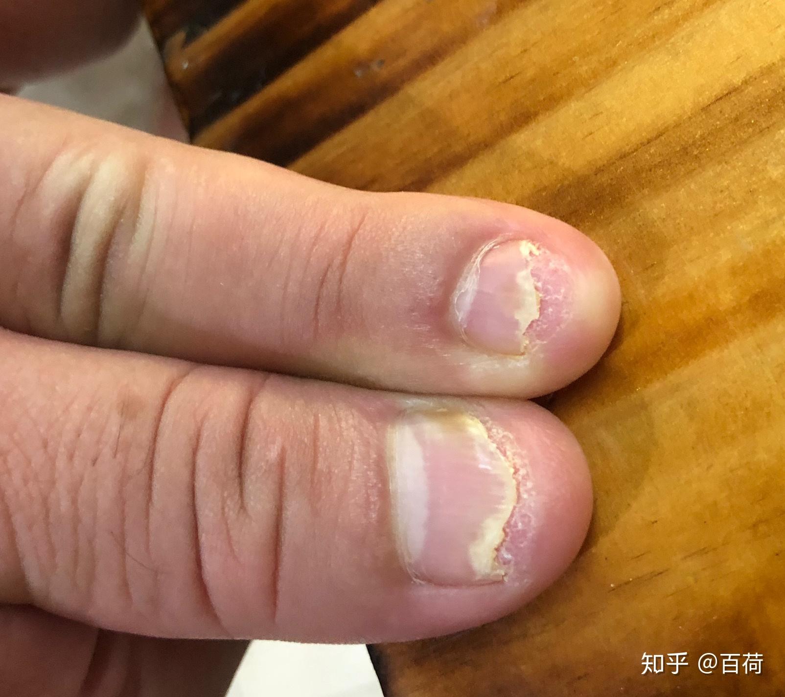 请问我这手指甲是怎么回事啊