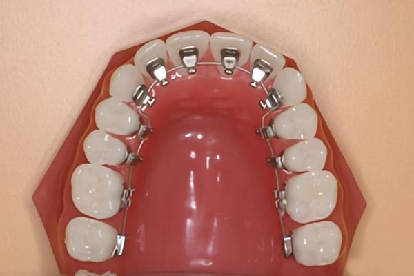 (一)传统金属托槽矫正图源网络金属托槽矫正使用的是传统的钢牙套,将