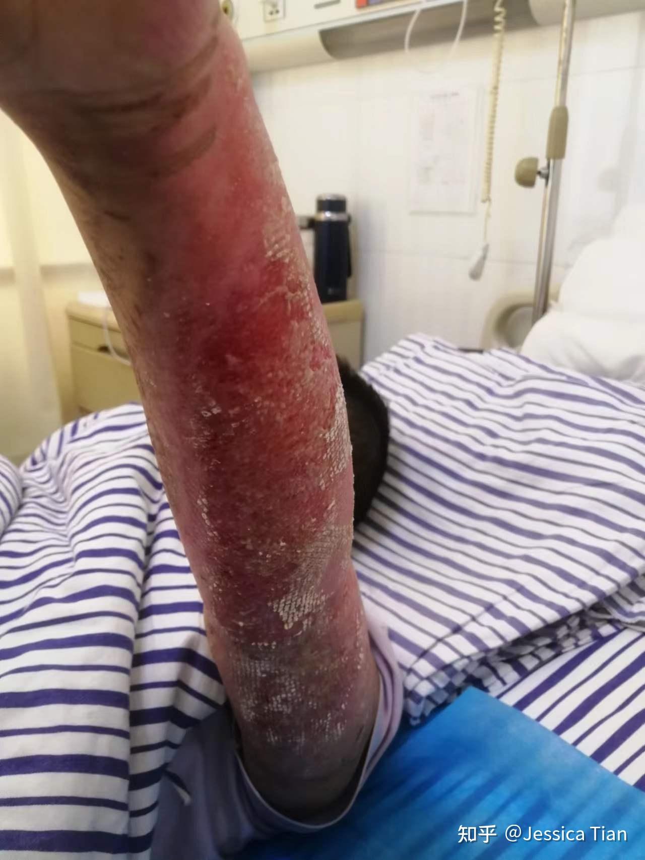 烧伤康复过程重二度和轻三度烧伤面积30