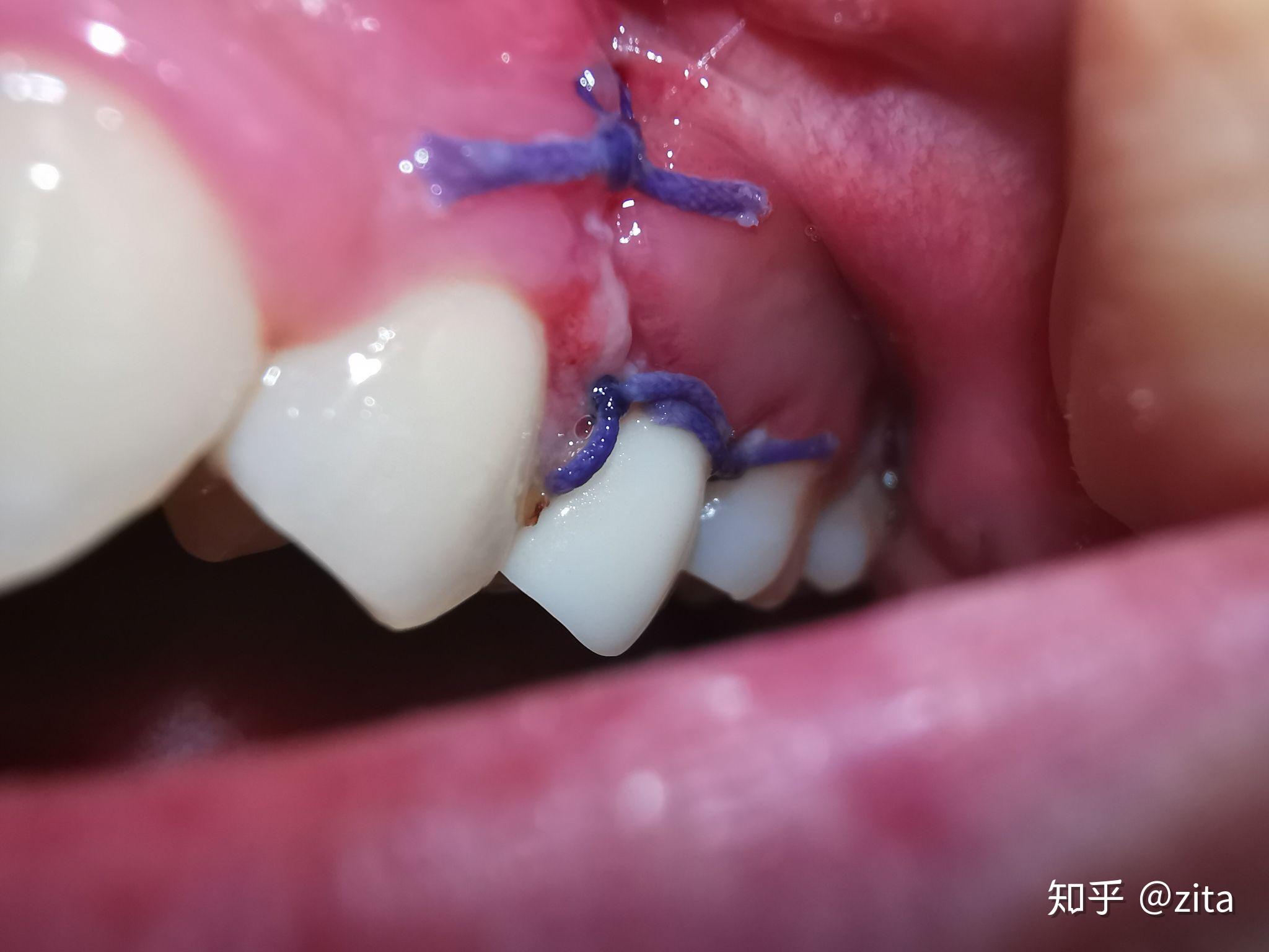 牙根管系统详解 - 口腔医学 - 天山医学院