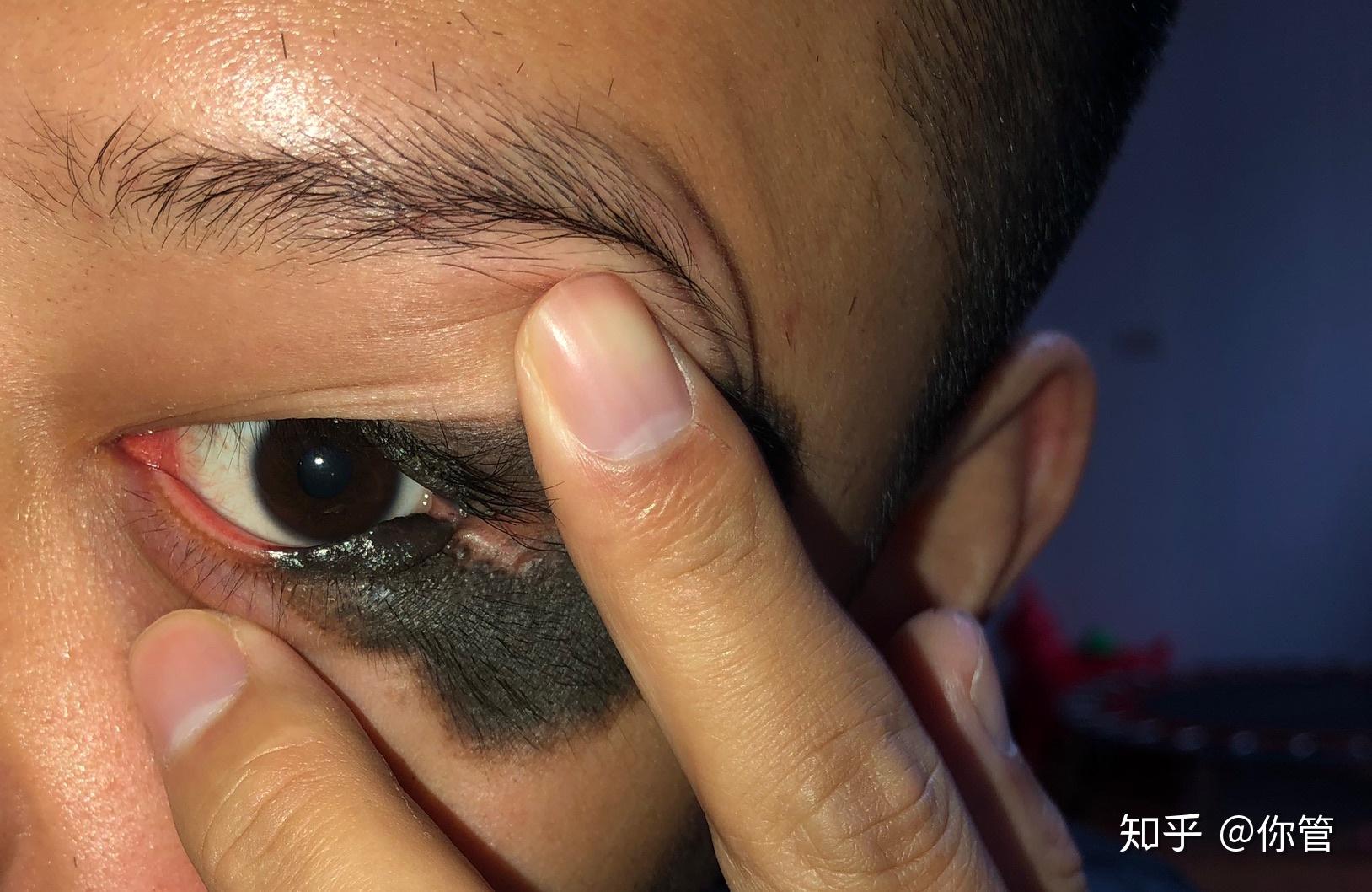 跪求全国胎记治疗最好的医院