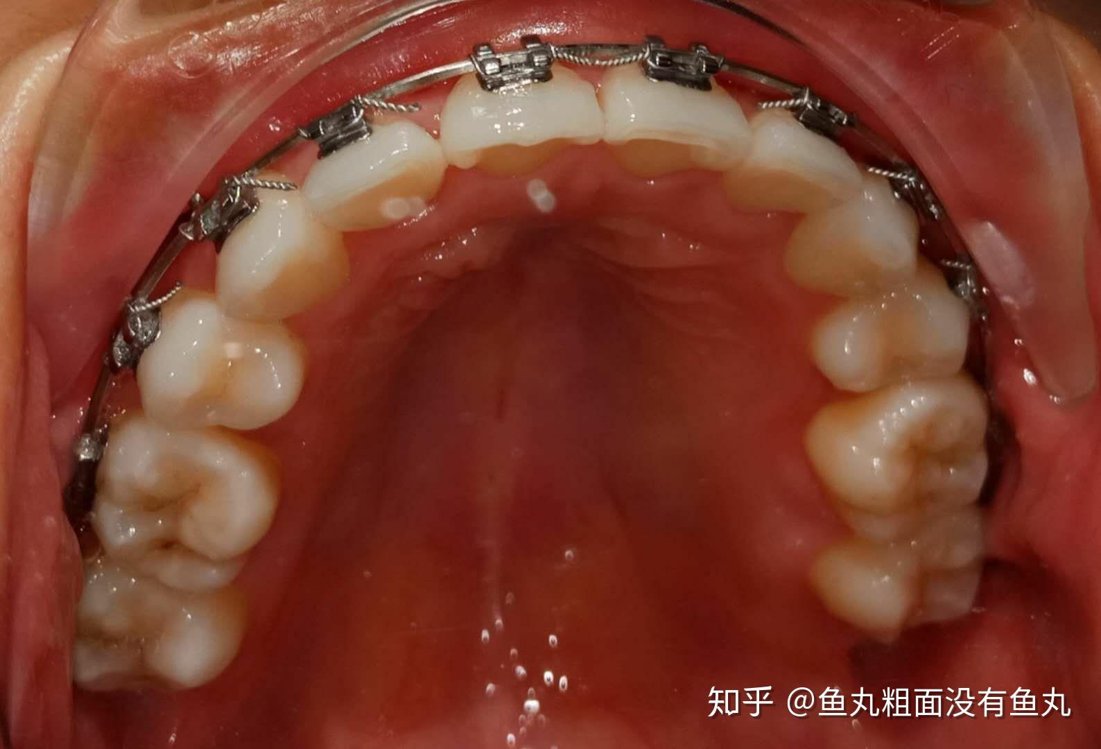 医生说还有几个月就可以摘牙套了,开心