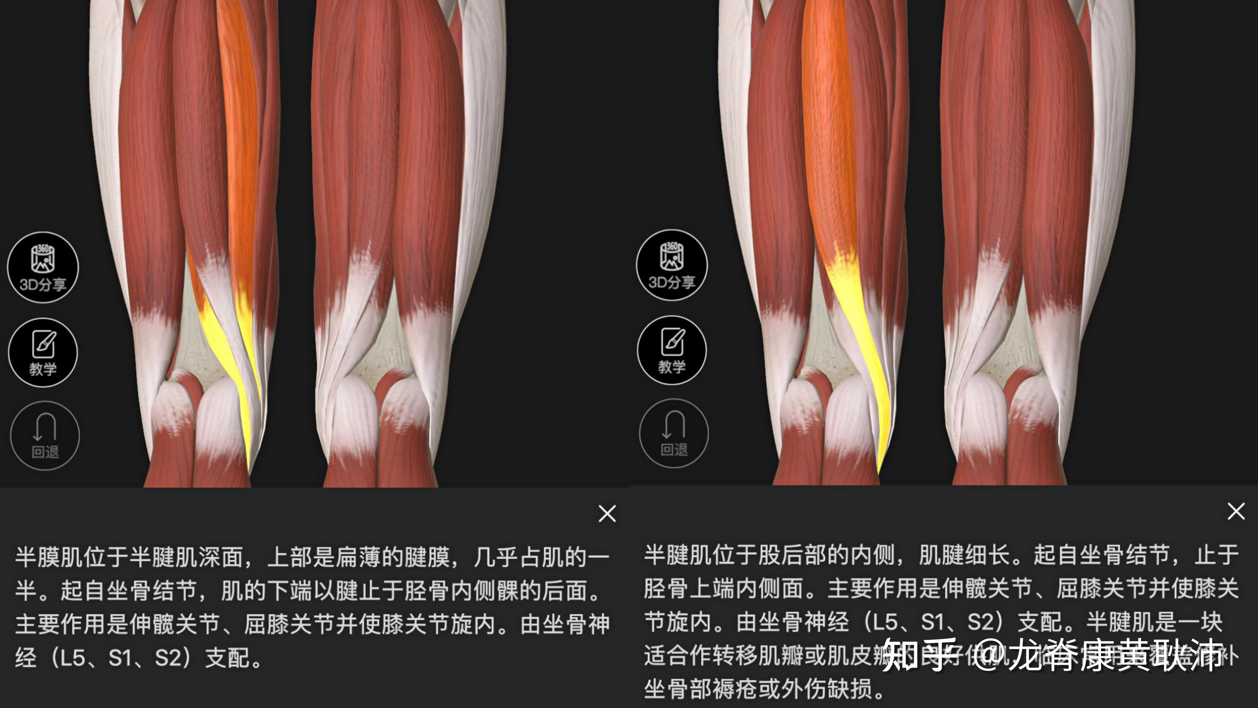 严重破坏膝关节的内侧稳定, acl损伤后一般会激活腘绳肌来代偿acl的