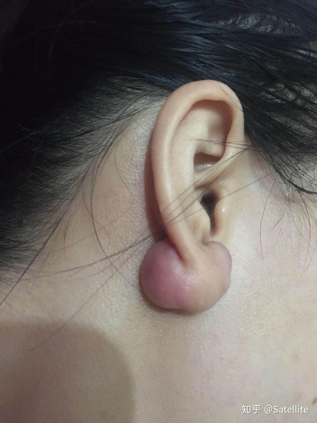 怎么判断耳洞疤痕疙瘩图片