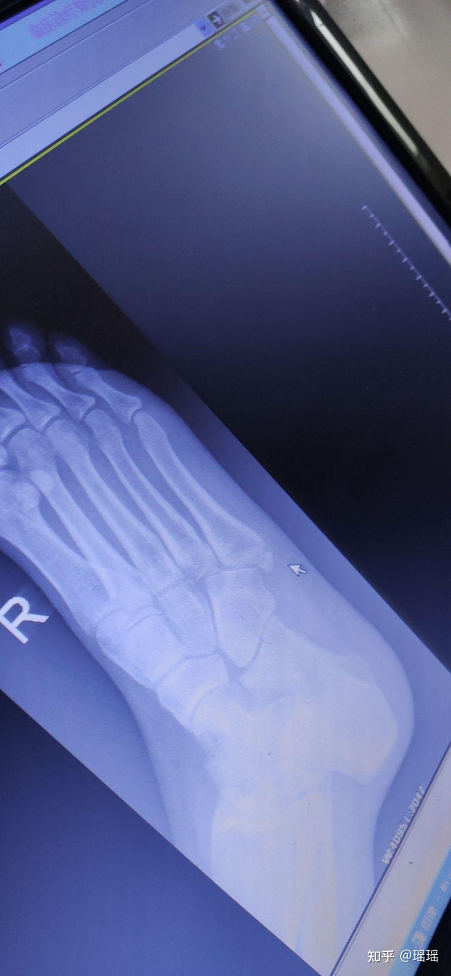 右脚第五趾骨骨折治疗经历
