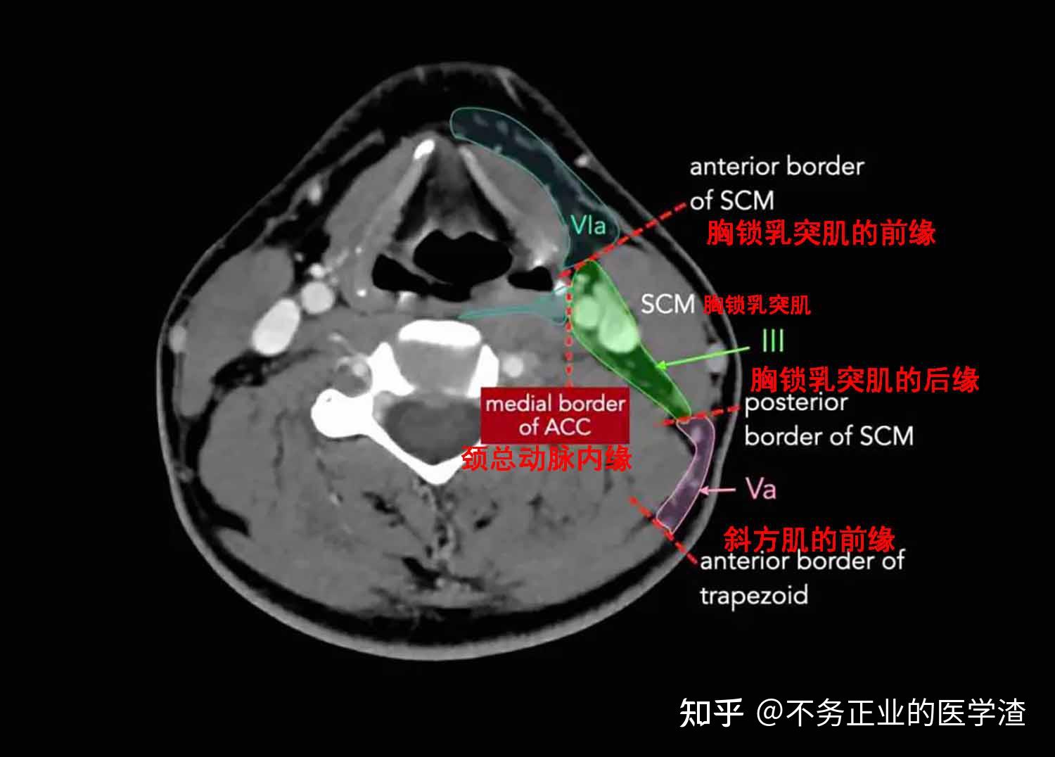 2013颈部淋巴结分区