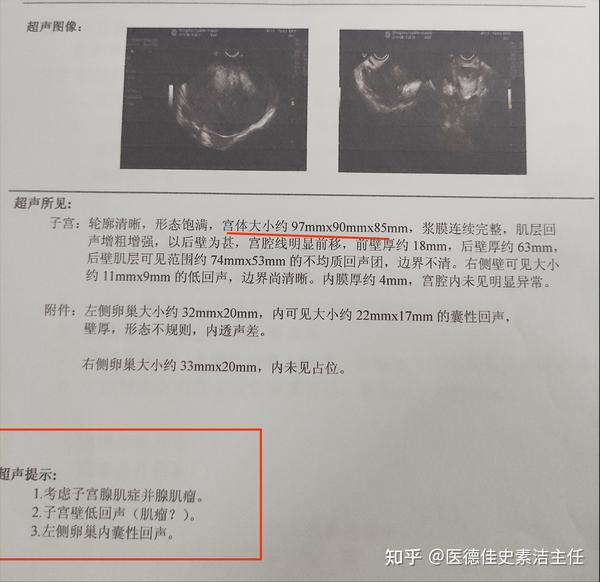 子宫腺肌症,必须要切掉子宫才能好吗?医生:不是 - 知乎