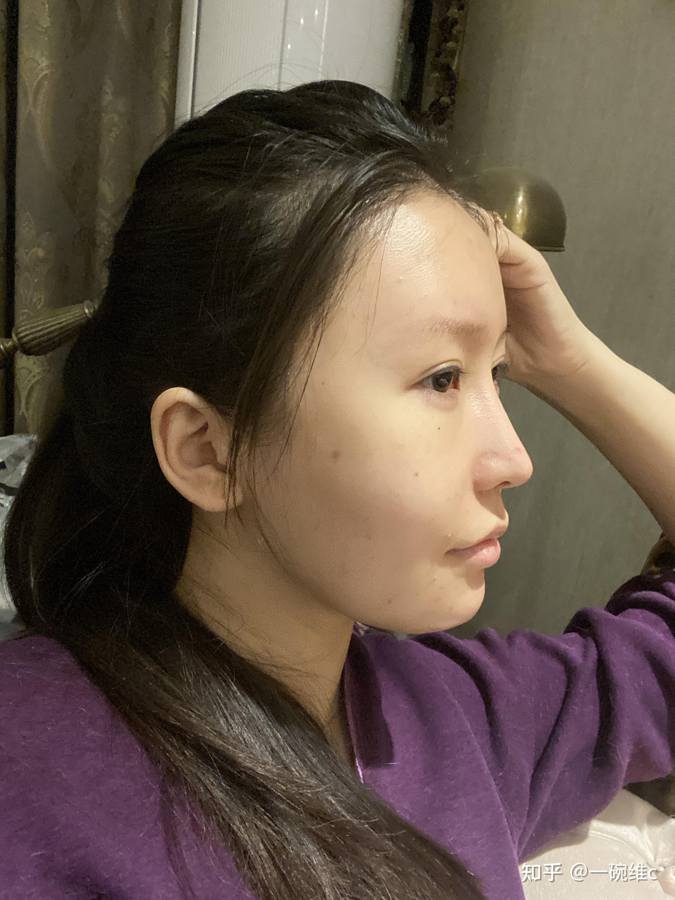 聊聊嘴凸矫正 - 知乎