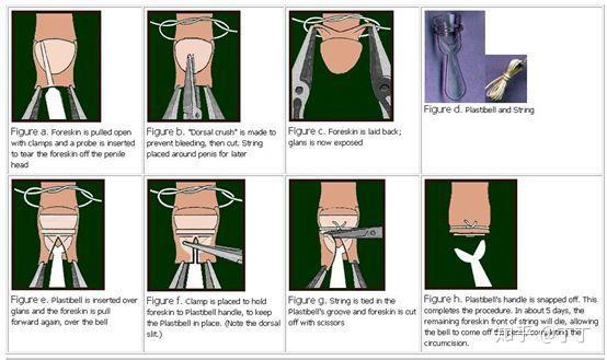 小儿包皮手术是怎么做的手术攻略了解一下