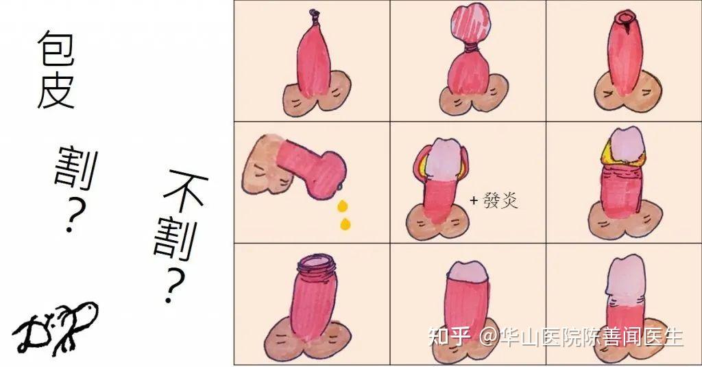 包皮过长一定要割包皮吗?除了手术之外,原来还可以这样做