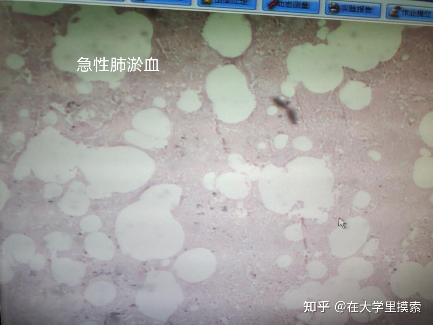 病理学切片:肺淤血、肝淤血、脾淤血 - 知乎