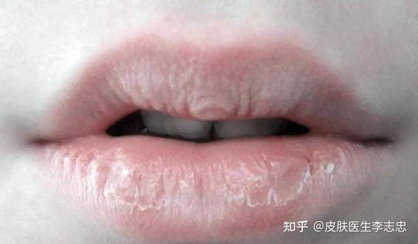 唇炎的中医治疗 - 知乎