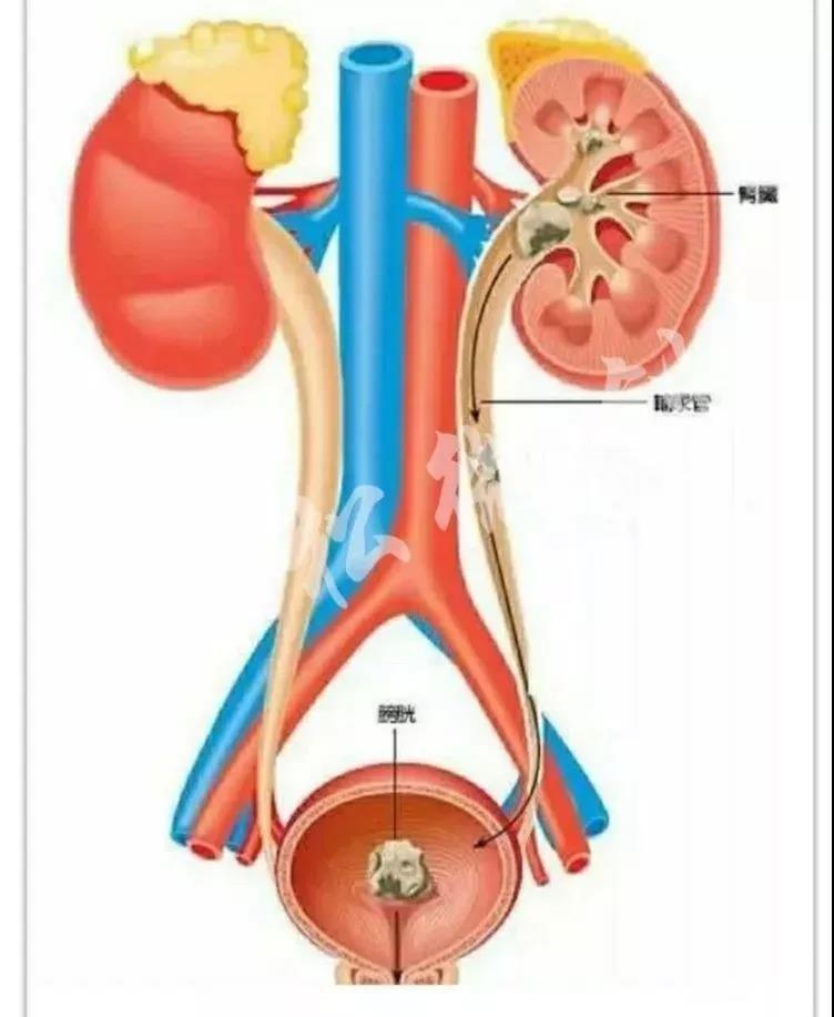 输尿管痉挛图片