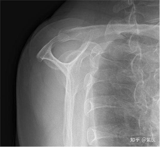 高尚影像特色技术系列(五)| DR摄影特殊摆位-冈上肌出口位(Y形位) - 知乎