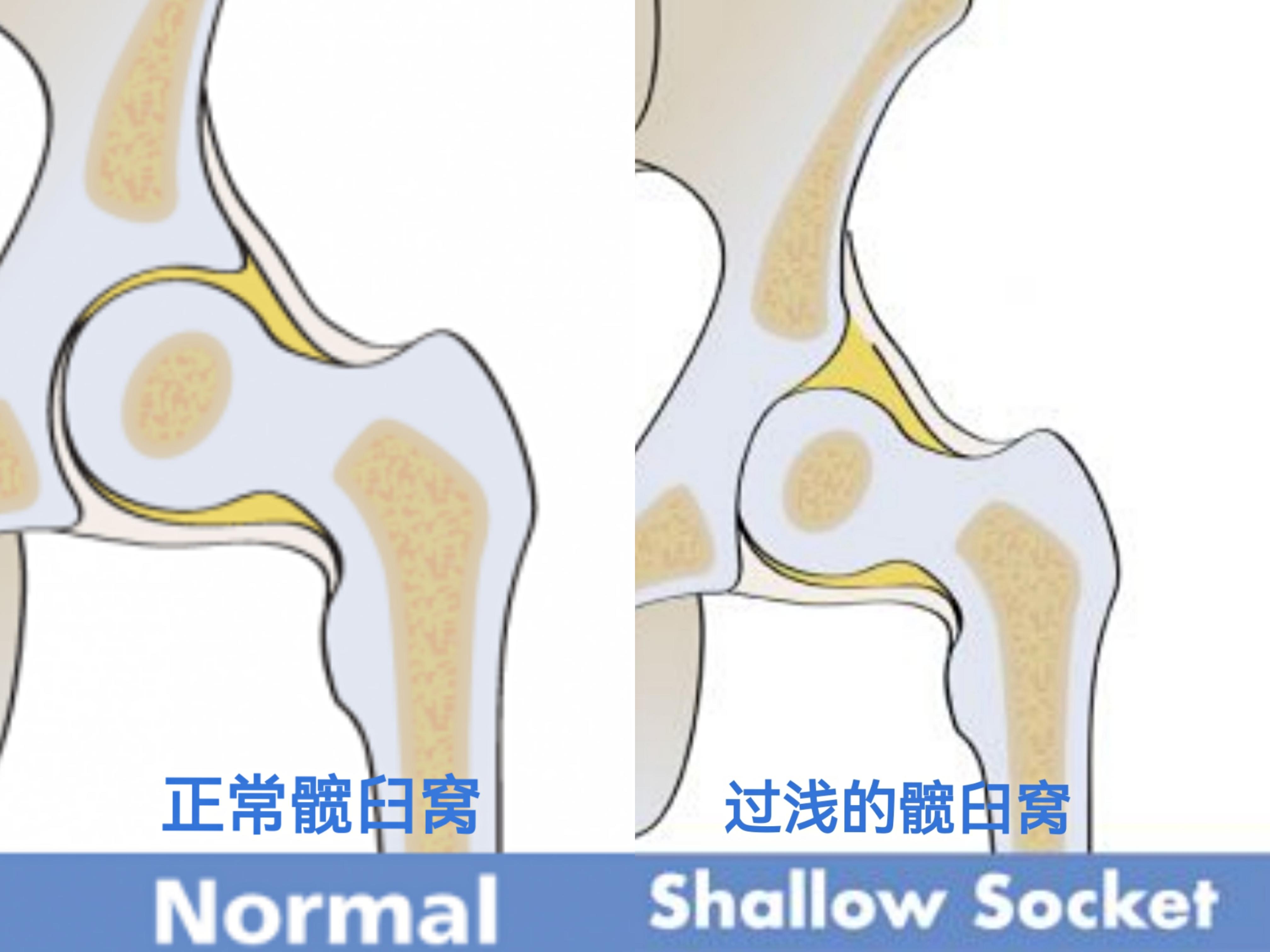 髋关节发育不良的表现图片