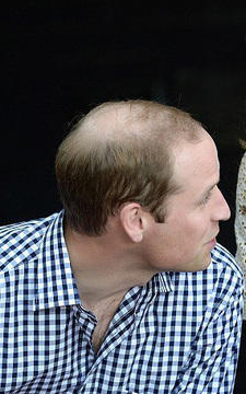 植发有害吗,为什么威廉王子脱发挺厉害的,却没