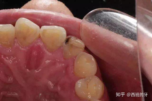 塞牙缝让人抓狂怎么办