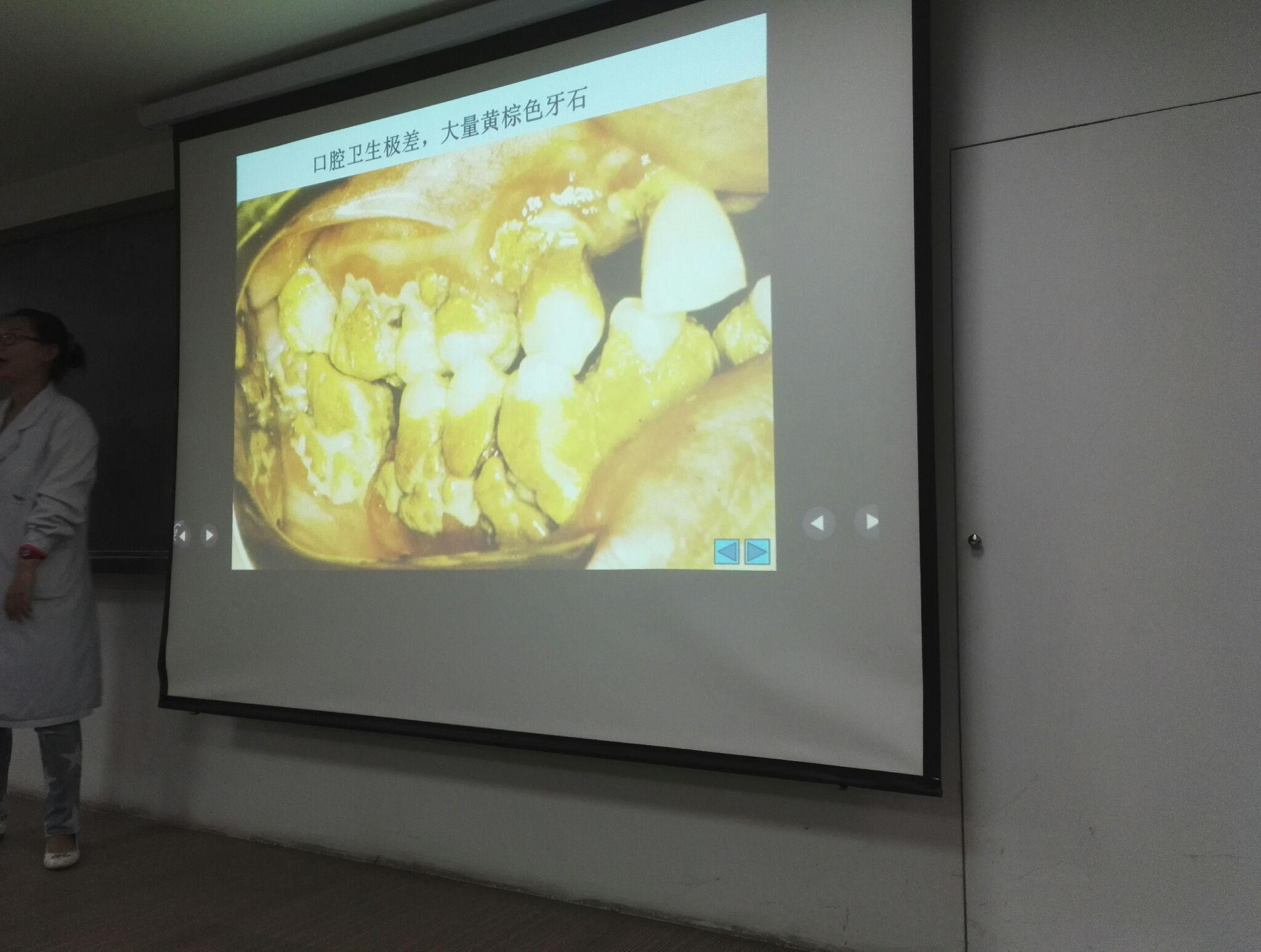 牙医碰见最烂的牙有多烂?