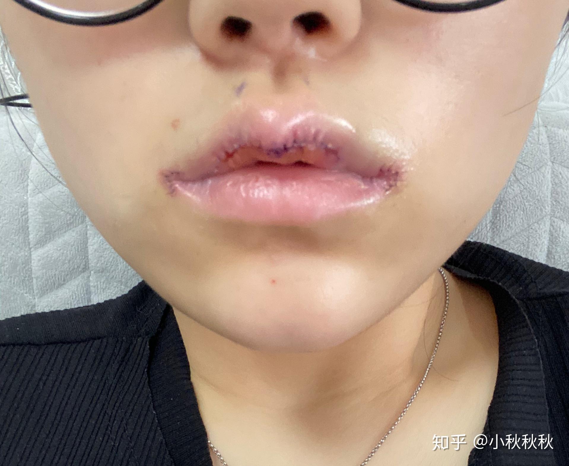 唇综合手术唇珠77嘴角上扬