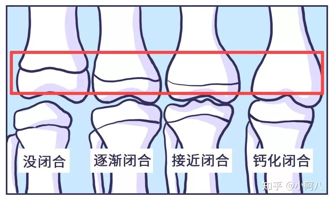 哪些情况会导致骨骺线早闭