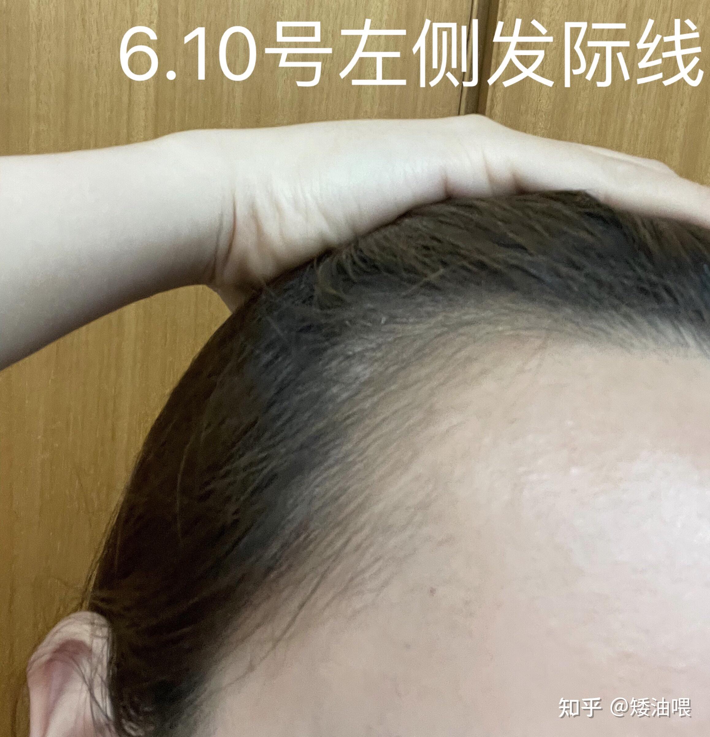 拯救发际线第80天两个月明显解决发缝稀疏的问题改善发际线凹陷