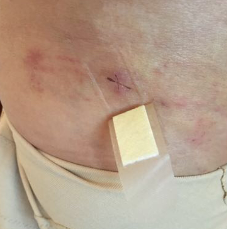 大腿吸脂术后护理恢复过程吸脂后该怎样做才能达到理想瘦腿效果