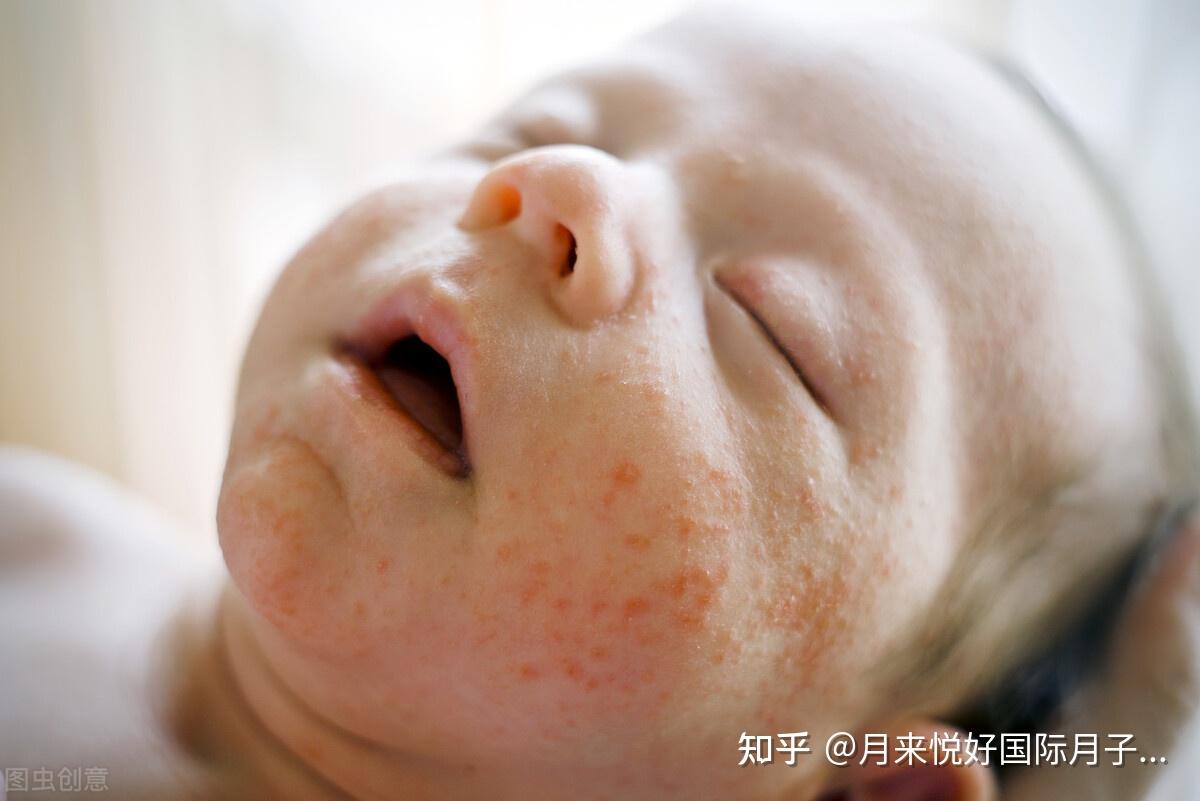 新生儿宝宝出湿疹了，宝爸宝妈该如何处理？__小豆苗疫苗助手