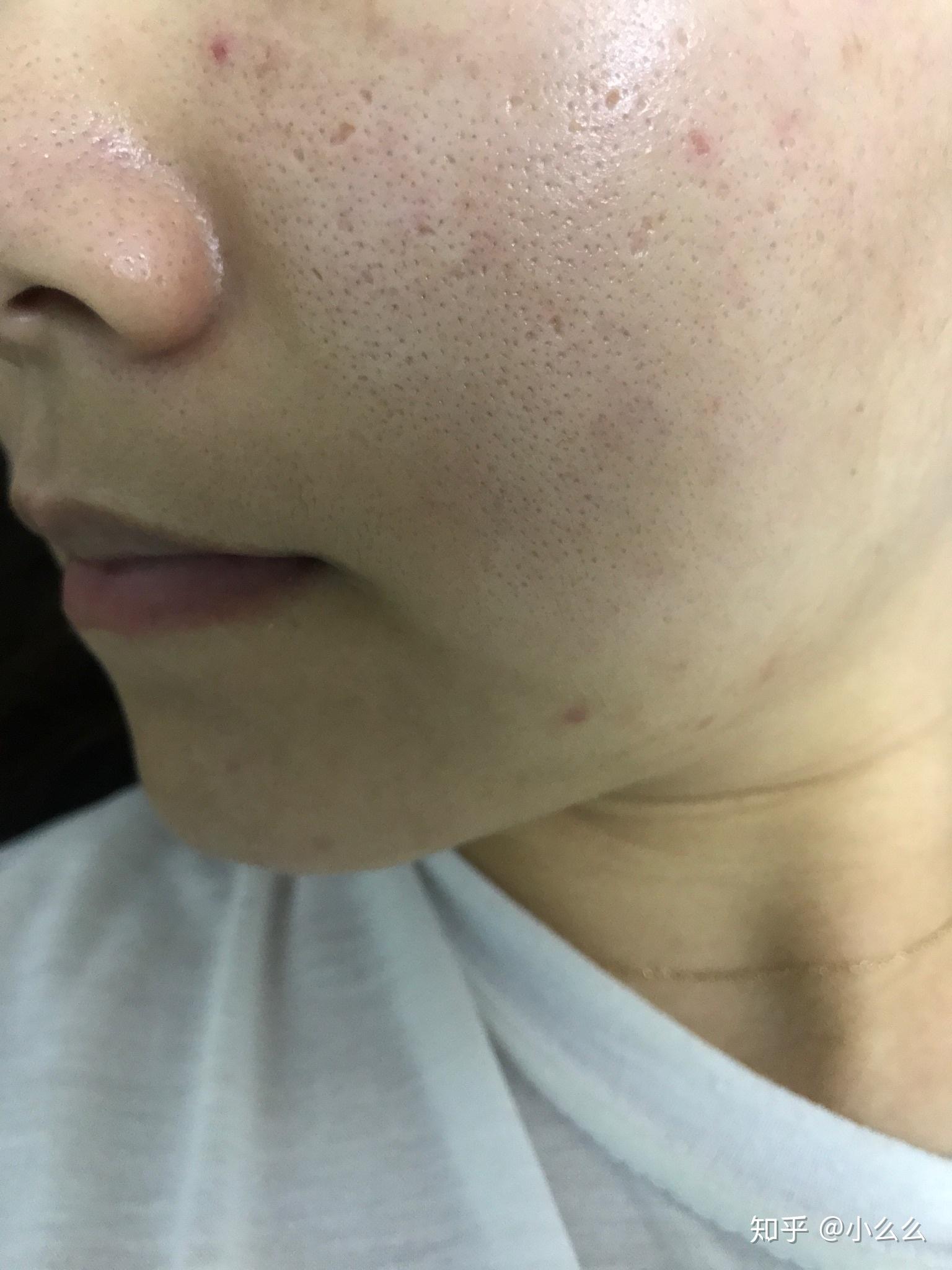 本人痘坑毛孔粗到可以插秧点阵激光祛痘坑两次对比持续更新