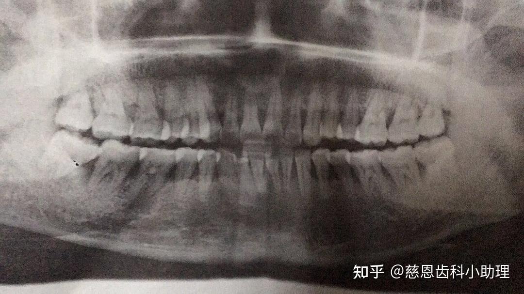 深圳牙齒矯正丨正畸要不要拔牙看這三點