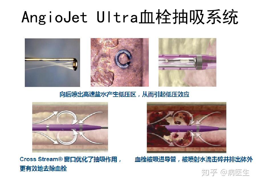 人工血管内瘘血栓介入治疗——血栓减容方式 - 知乎