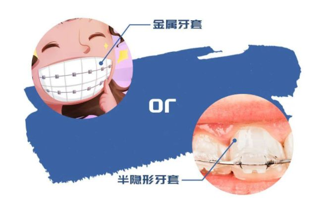 矯正牙齒費用多少合理為什麼矯正費用差距大影響價格因素