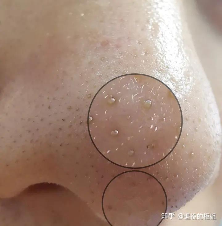 到底啥是真黑头,啥是"假黑头"?