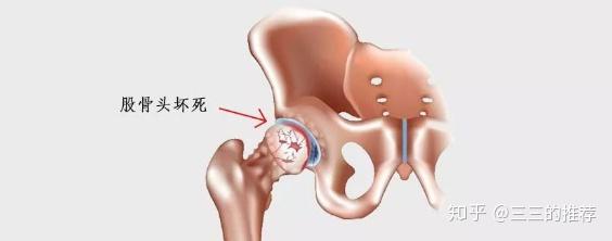 股骨頭壞死的早期症狀是什麼股骨頭壞死怎樣治療