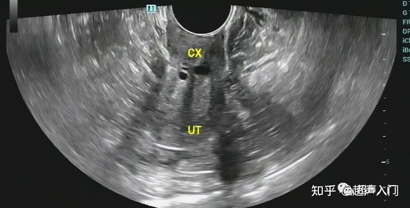 初學超聲如何準確判斷子宮的位置