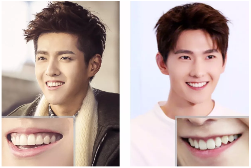 及牙龈的显露量将微笑分为三类, 分别为低位笑线,中位笑线,高位笑线