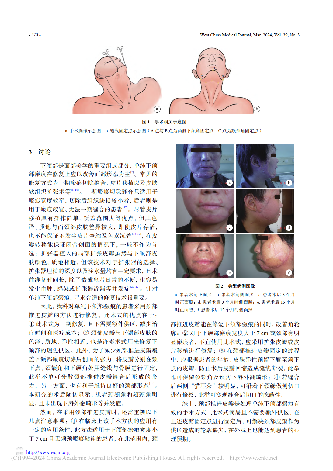 推进皮瓣修复下颌部瘢痕的临床应用 - 知乎