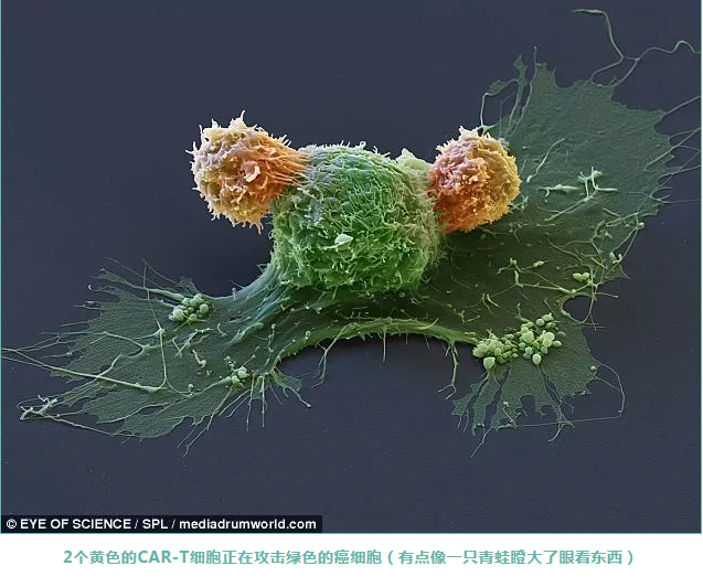 cart细胞如何杀灭癌细胞11张图带你了解