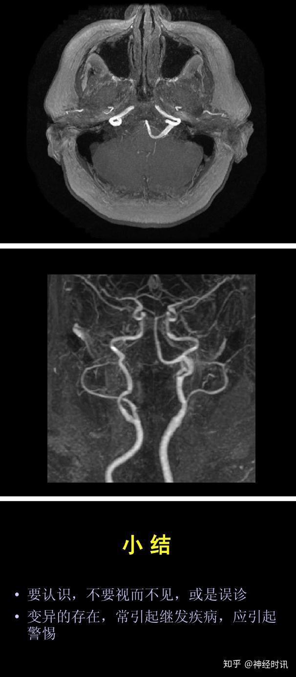 是颈内动脉系,椎一基底动脉还是连接他们的willis环均位于脑的腹侧面